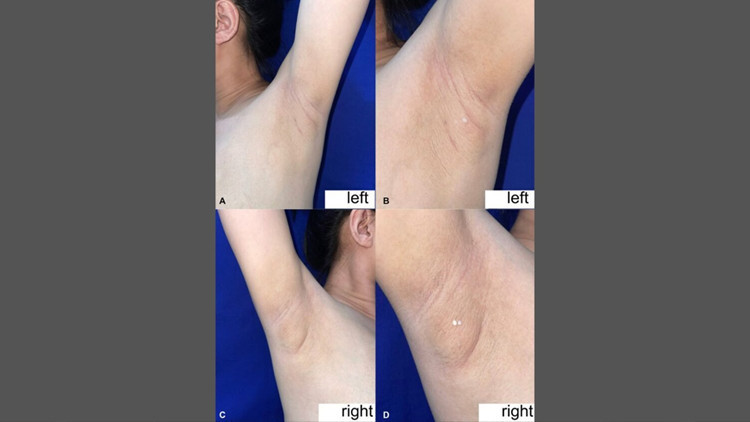 filipinli kadinin koltukaltindan sut geldi nadir gorulen durumun nedeni ne v9GMv9R1.jpg